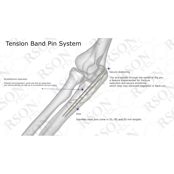 Tension Band Pin System 